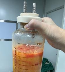 武威水动力吸脂手术要做多久？